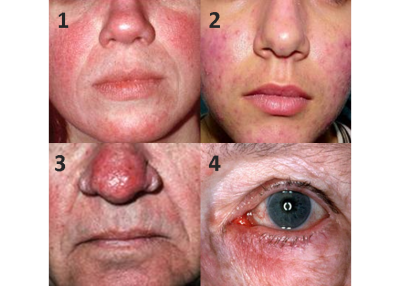 skin care for rosacea